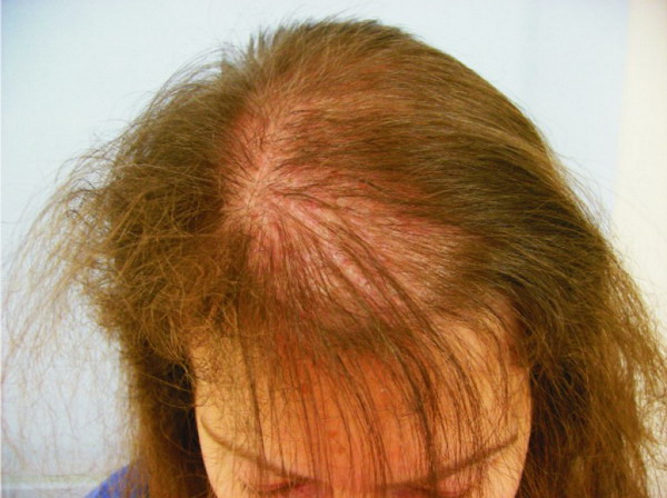 Диффузное телогеновое выпадение волос у женщин лечение