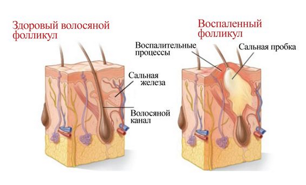 рубцовая алопеция у женщин