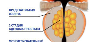 стадии аденомы простаты