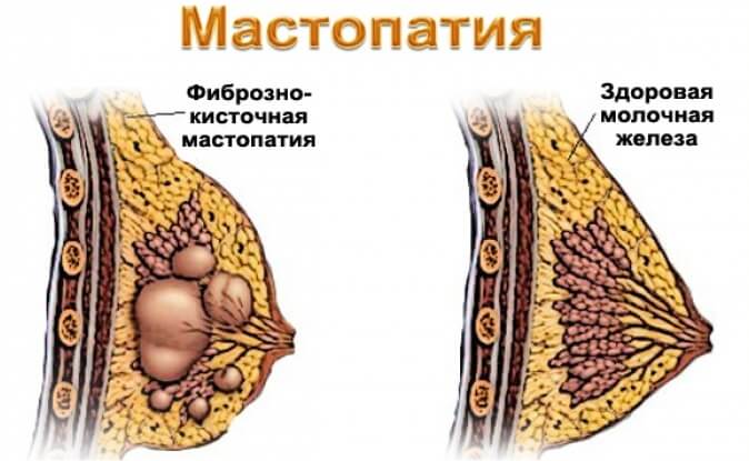 мастопатия диффузно кистозная