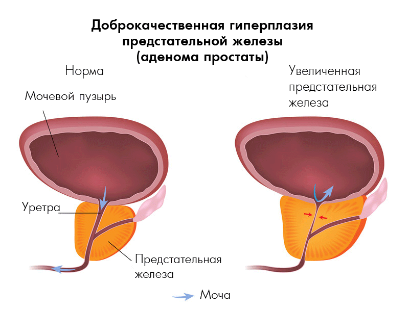 доброкачественная гиперплазия