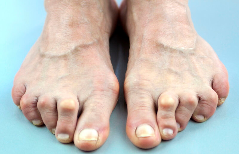 Шишки на пальцах ног сверху причины и лечение thumbnail