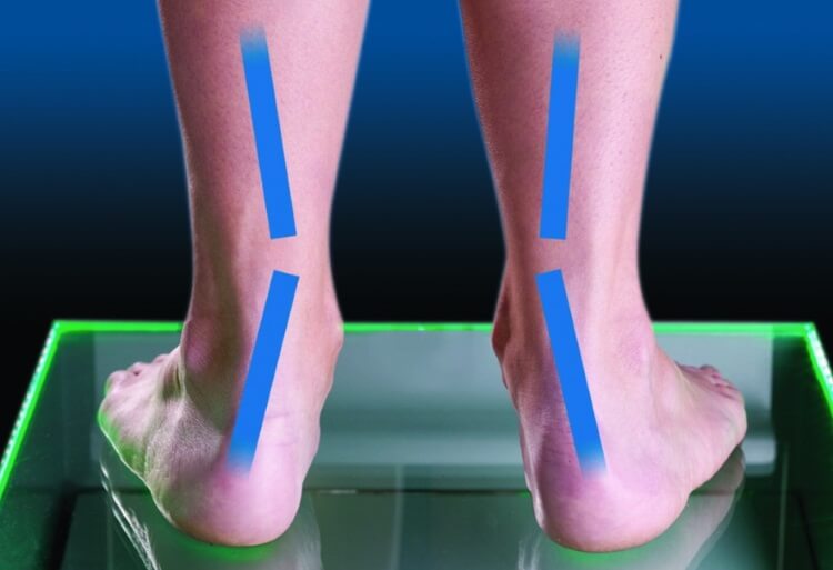 Вальгусная деформация ног у взрослых лечение thumbnail